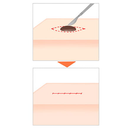 切除縫合法イメージ図