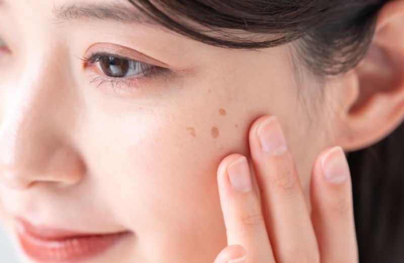 Qスイッチルビーレーザー