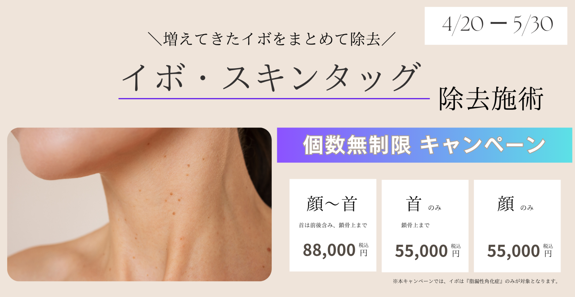 イボ・スキンタッグ